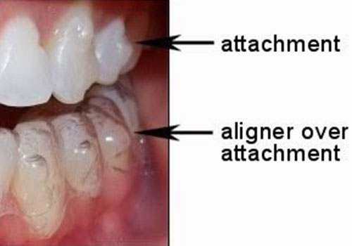 Closeup of Invisalign attachment